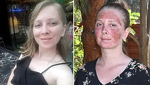 CİLT BAKIMI YAPTIRAN MÜGE'NİN YÜZÜNDE 2'NCİ DERECE YANIK OLUŞTU